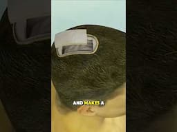 Brain tumor Removal surgery: Craniotomy (3d animation) #brainsurgery #tumortreatment