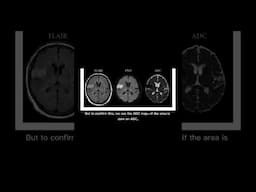 What does a stroke look like on a brain?DWI and ADC sequence #mri