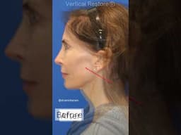 STUNNING Vertical Restore Facelift Transformation!