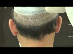 FUT Linear Scar Example After Strip Hair Transplant Surgery