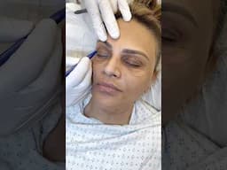 Natural Rejuvenation Under Local Anesthesia — Eyelid Lift + Fat Transfer