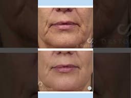 Before & After Fractional CO2 Laser Treatments