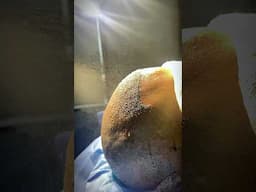 Post-op hair transplant: after 9 years of hair loss, he finally took action #vincihairclinic #shorts