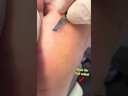 Glass Stuck Deep in Foot For Months — Watch the Satisfying Removal!