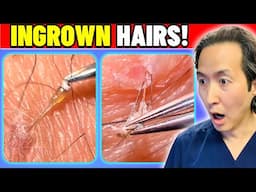 Plastic Surgeon Reacts to EXTREME Ingrown Hair Extractions!