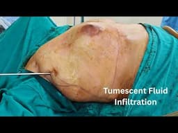 Grade 4 Gynecomastia Surgery | Male Breast Reduction Transformation | BLINIQ Cosmetic Surgery Centre
