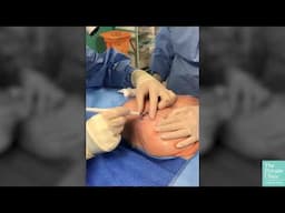 Behind the scenes of a Breast Augmentation