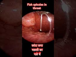 मछली का काँटा गले में फँस गया।  #foreignbody #throat #fishbone