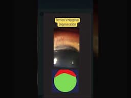 4 Types of Primary Corneal Ectasia You MUST Know 👁️🔥 #ophthalmology