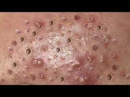 Loan Nguyen Acne Treatment 70x