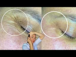 Remove Under Eye Wrinkles | Better Than BOTOX | BOOST COLLAGEN UNDER THE EYES