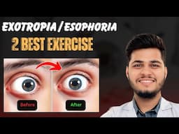 SQUINT सही करने की 2 असरदार एक्सरसाइज | सिर्फ 1 महीने में फर्क देखें | Squint Exercise