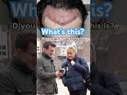 Doctor explains male hair transplant #shorts