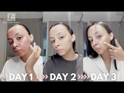 Korean Acne & Acne Scar Treatment That Actually Worked | Seoul Guide Medical