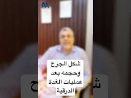 شكل الجرح وحجمه بعد عمليات الغده الدرقيه