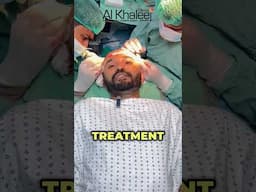 hair transplant in Karachi  low cost #alkhaleejclinics  #hairtransplantresults