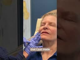 Smooth Upper Lip Lines with Subtle Filler