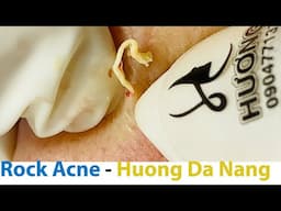 Acne Treatment Huong Da Nang#729  Hard acne