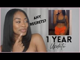One Year Tummy Tuck Update | Umbilical Hernia Repair