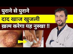 पुराने से पुराने दाद, खाज और खुजली जड़ से ख़त्म करेगा यह नुस्खा | best cream for fungal infection