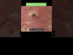 Who loves the GIANT blackheads 🙋🏻 ♀️