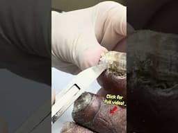 Cutting 4 YEARS of Neglected Toenails 😳 #Satisfying & Shocking! #satisfyingshorts #nailcutting