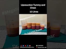 Liposuction to Reshape your body