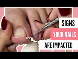 Foot Restoration: Fixing Thick Toenails, Calluses, and Athlete’s Foot | Meticulous Manicurist