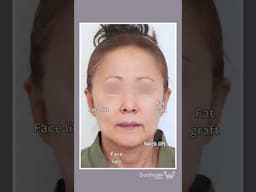 Face lift surgery in Korea. Antiaging surgery #facelift #antiaging #plasticsurgerykorea