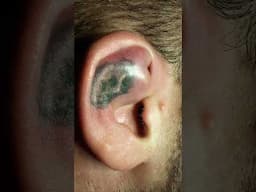 Gobhi jaisa kaan : Boxer ki pehchaan । Cauliflower ear । Dr Rajive Bhatia  #ear #shorts