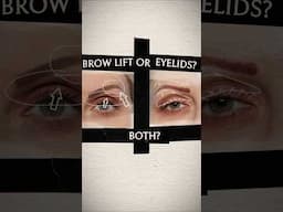 BROW LIFT can replace a BLEPHAROPLASTY… let me explain #eyelidlift #browlift