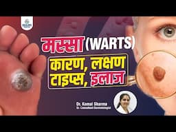 मस्से (Viral Warts) क्यों होते हैं? कैसे फैलते हैं: मस्से हटाने के 5 तरीके: लेजर या घरेलू उपाय