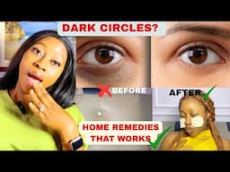 How to Get rid of dark circles & Hyperpigmentation Fast |5 DIYS✅,Permanent Solution✅|