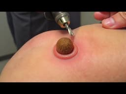 a ball got stuck in his skin..