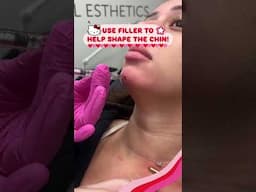 Use Filler to Help Shape the Chin