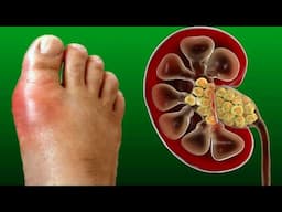 High And Low Uric Acid Levels: Causes And Treatment