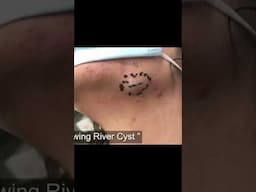 Go watch “A Flowing River Cyst” on YT for the full procedure including the sac extraction! ✌🏼❤️💥