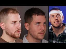 Shocking Surgery Results! 😱 Before & After - 6 Month Hair Transplant Recovery (FUE)