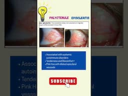Episcleritis V/S Conjunctival Phlyctenule 🔥 #ophthalmology