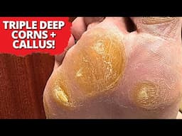 Giant Corns and Cracked Callus Pad Removed - Extreme Foot Transformation!