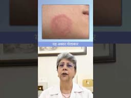 Face Fungal infection treatment || चेहरे पर फंगल इन्फेक्शन का इलाज
