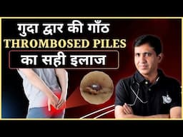 गुदा द्वार की गाँठ का बाहर आना | Thrombosed Piles | गुदा द्वार की गाँठ का सही इलाज