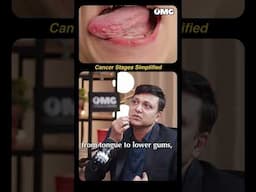 How to Identify Cancer Stage 1, 2 or 3?