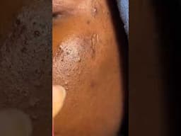 1 Minute Of Top ASMR Pimple Popping Video №95