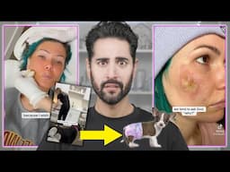 The TikTok Chemical Peel From Hell!