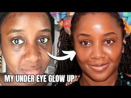 EVERYTHING I Did for My Hollow Under Eyes & Dark Circles
