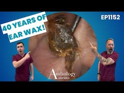 40 Years Of Ear Wax Blocking This Patient’s Ear! - EP1152