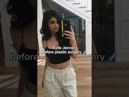 kylie jenner before surgery...