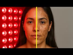 Is Red Light Therapy Safe For Melasma? SURPRISING Science!