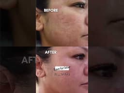 One device. Countless skin concerns. Venus Viva is your resurfacing powerhouse. ✨